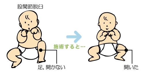 股関節脱臼、足開かない 開いた