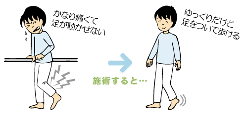 かなり痛くて足が動かせない、ゆっくりだけど足をついて歩ける